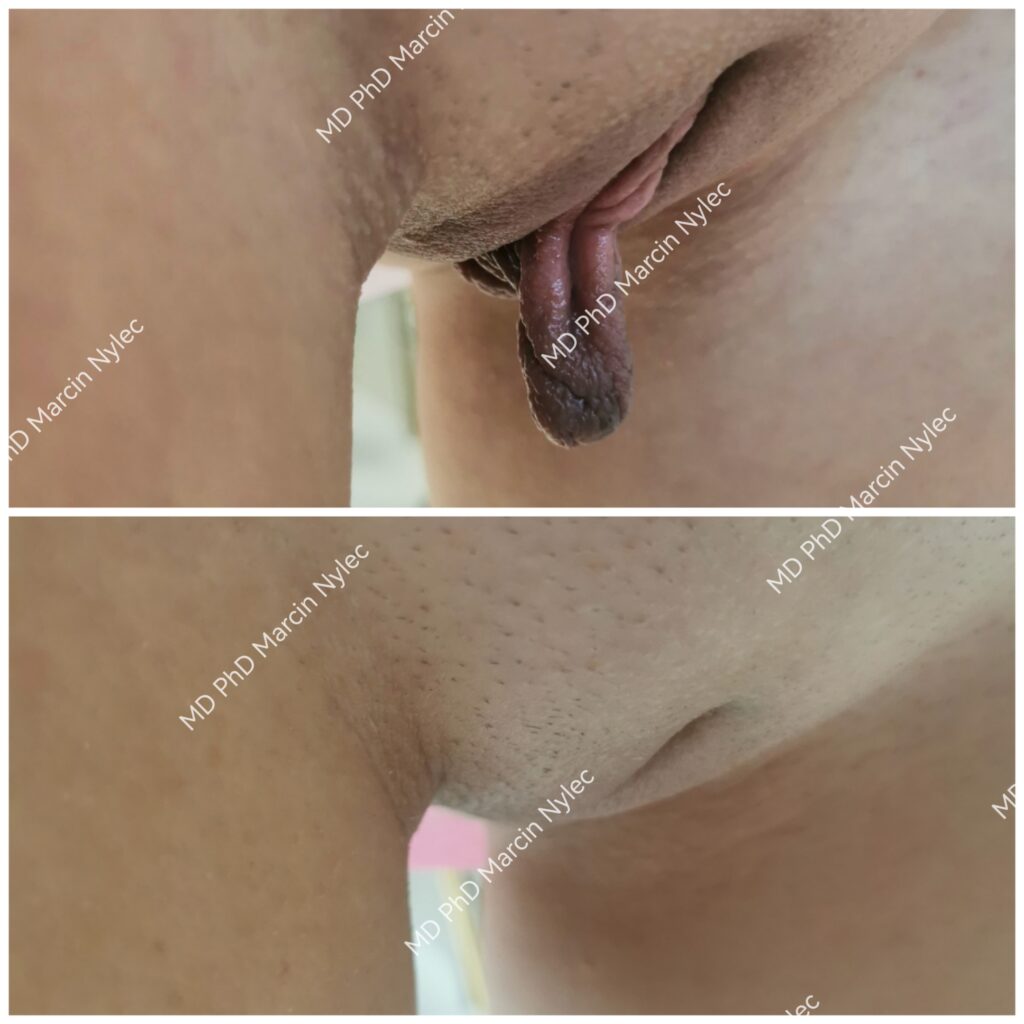 Labioplastiske effekter - før og etter bilder.