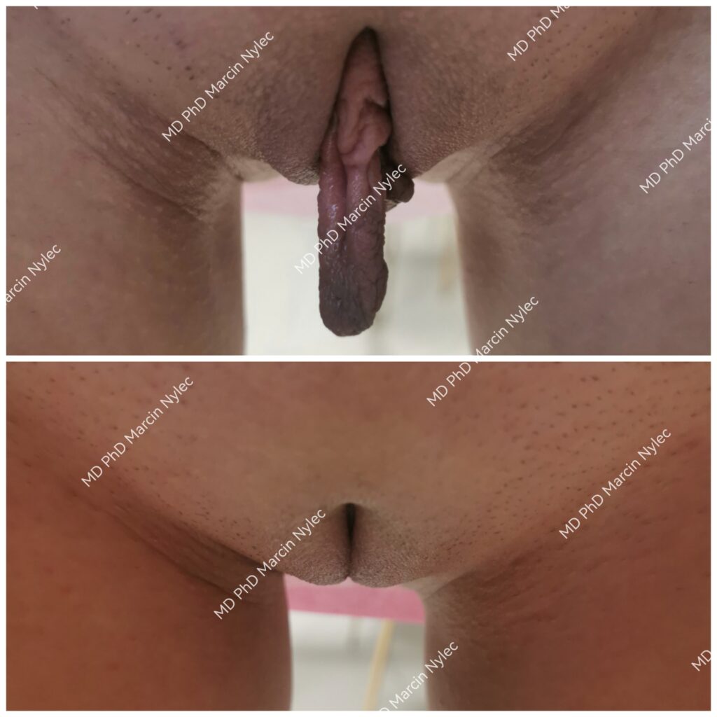 Labiaplasty bilder - detaljert før og etter.
