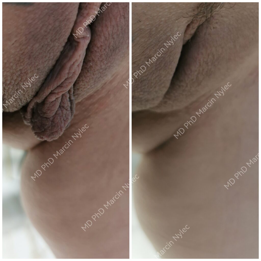 Labioplastikk beste resultater - transformasjon i bilder.