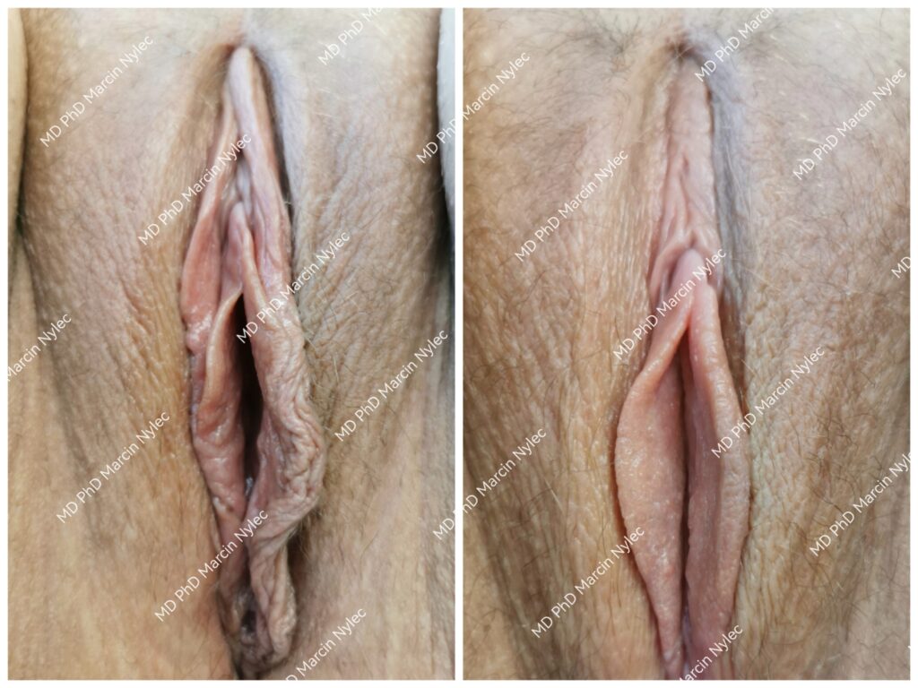 Beste resultater av labioplastikk - detaljerte før- og etterbilder.