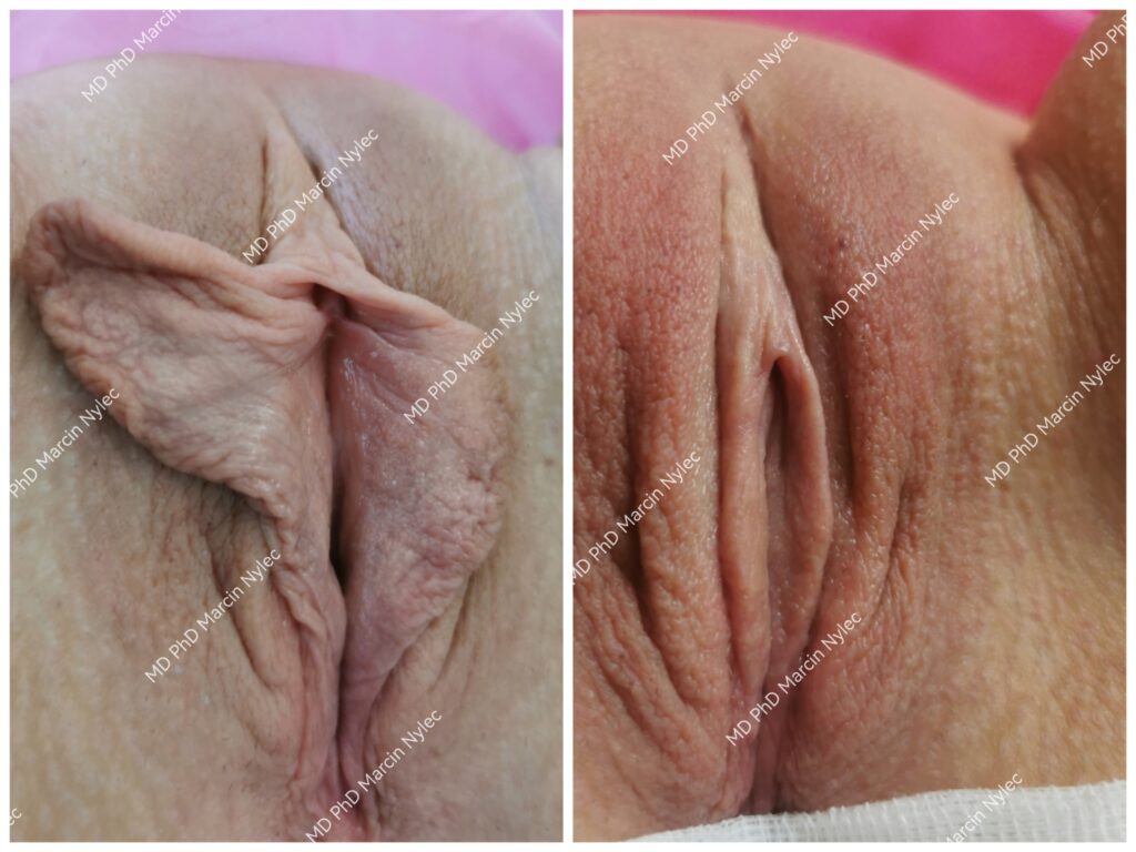 Før og etter labioplastikkeffekter - transformasjonsbilder.