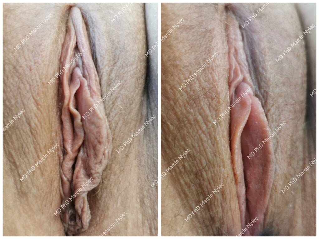 Labiaplastikkbilder - best før og etter operasjon.